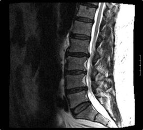 x-ray sa cervical spine nga adunay osteochondrosis
