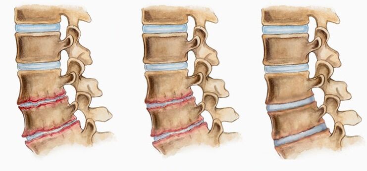 Ang deformation sa mga intervertebral disc sa osteochondrosis mahimong hinungdan sa sakit sa likod