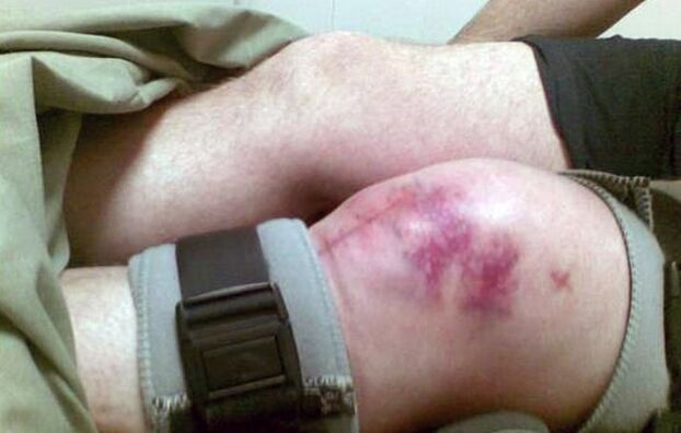 Ang mga hinungdan sa arthrosis sa lutahan sa tuhod