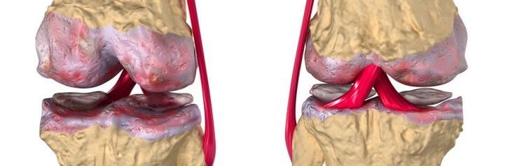 Himsog nga hiniusa ug arthrosis sa lutahan sa tuhod