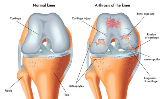 Normal nga hiniusa ug apektado sa arthrosis